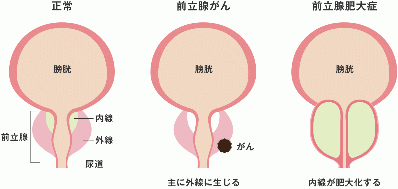 前立腺肥大症(ぜんりつせんひだいしょう)