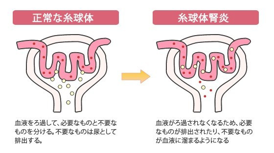 慢性糸球体腎炎（まんせいしきゅうたいじんえん）